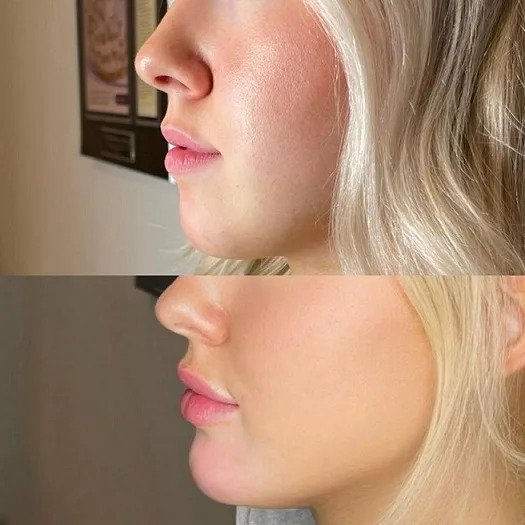 How the Best Plastic Surgeons in Dubai Use Chin Fillers to Enhance Facial Features