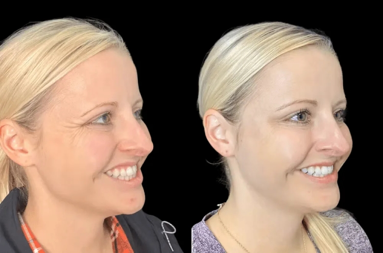 Best Plastic Surgeon in Dubai: Botox for a Youthful Look