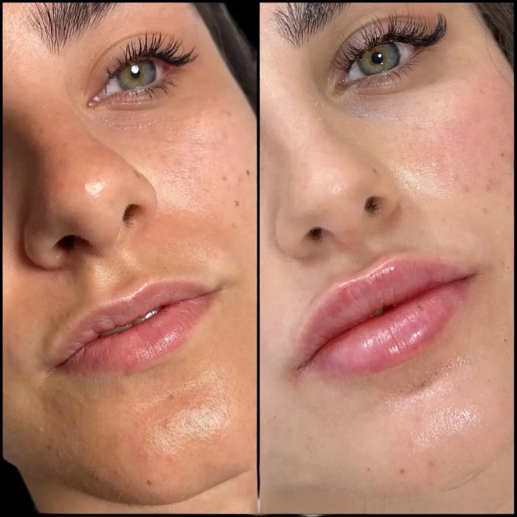 Best Doctors in dubai for Celebrity-Approved Fillers Treatments