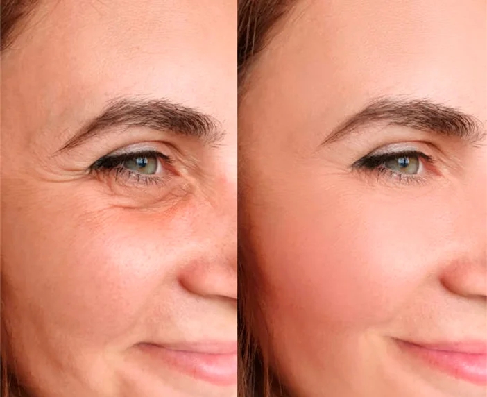 How Botox in Dubai Enhances Facial Symmetry for a Balanced Look