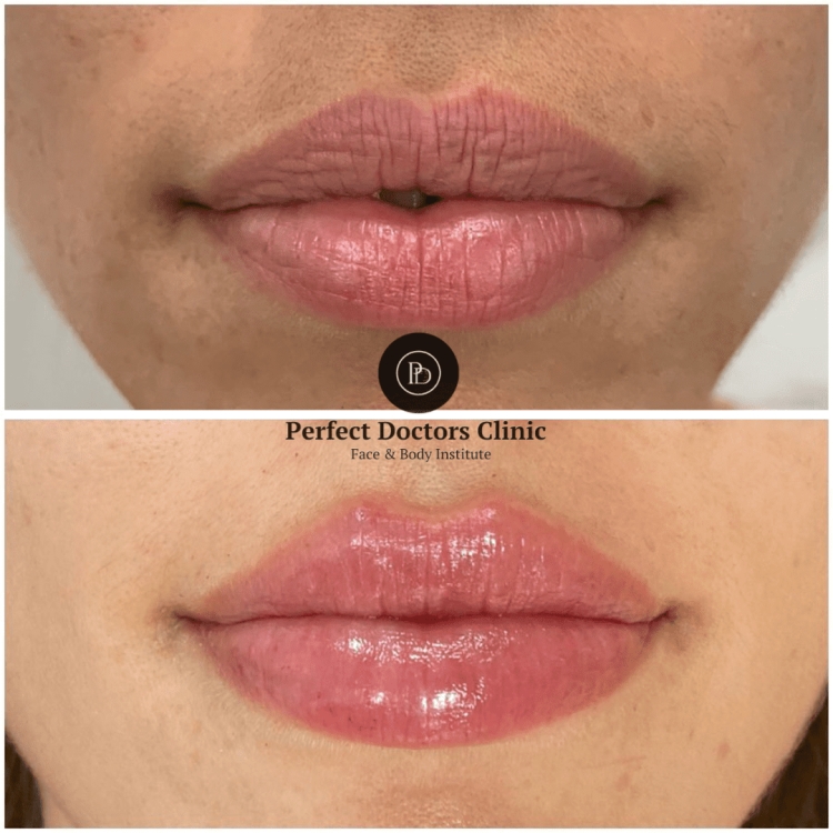Best Doctors in dubai Discuss How to Avoid Overdone Results with Dermal Fillers