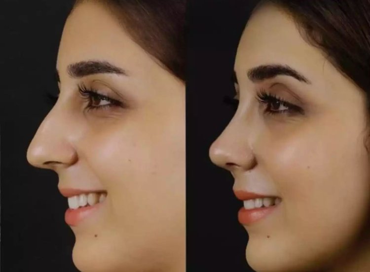 What Are the Risks Discussed by the Best Septoplasty Surgeons in Dubai?