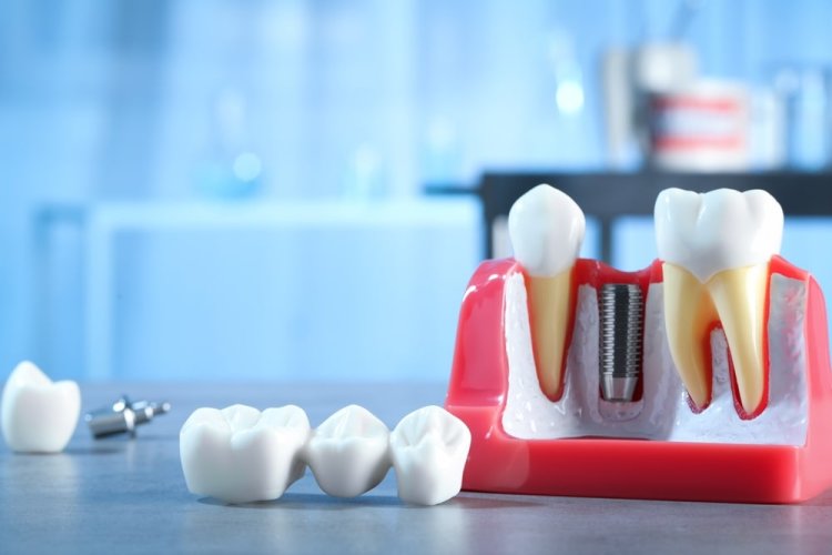 Strong Stable and Natural Dental Implants for a Confident Smile