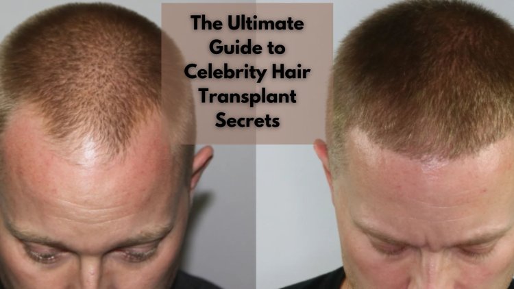 The Ultimate Guide to Celebrity Hair Transplant Secrets