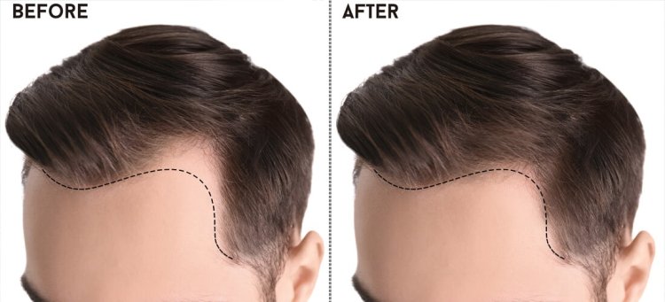 Choosing Excellence: The Definitive Guide to the Best Hair Transplant in Pakistan