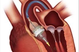 Transcatheter Heart Valve Replacement Market Trends Forecast Report 2025-2033