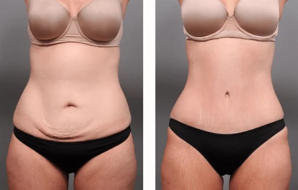 The Different Areas of the Body You Can Enhance with Fat Transfer Surgery in Dubai