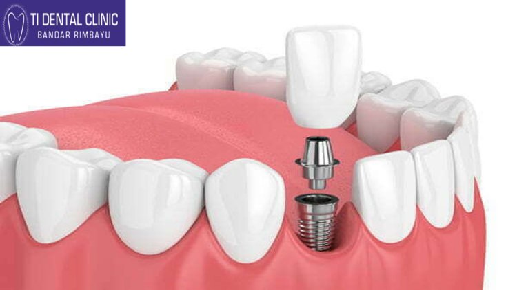 Invisible Braces: The Future of Kids’ Orthodontics at Tidental