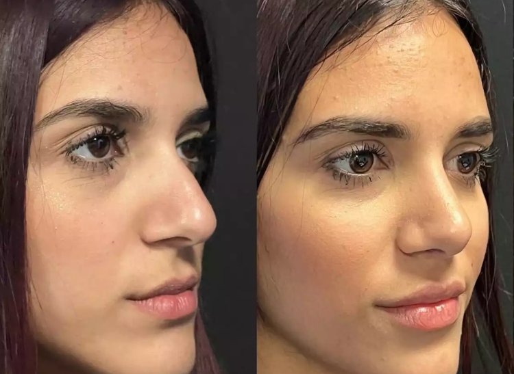 How the Best Septoplasty Surgeon in Dubai Helps with Chronic Nasal Issues