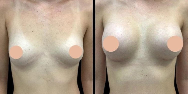 Best Doctors in Dubai Reveal How They Personalize Every Breast Augmentation Plan
