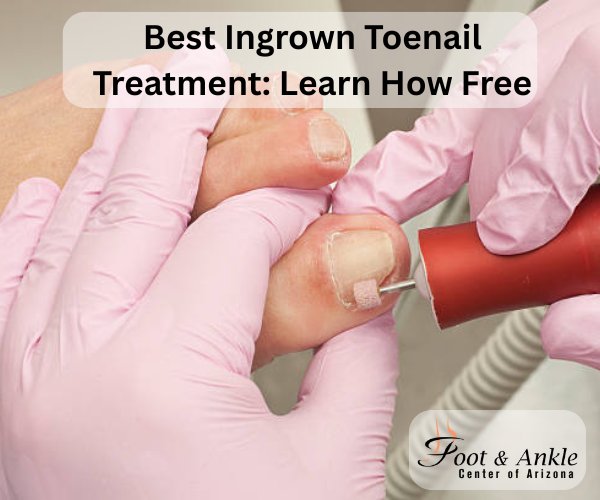 Best Ingrown Toenail Treatment: Learn How Free