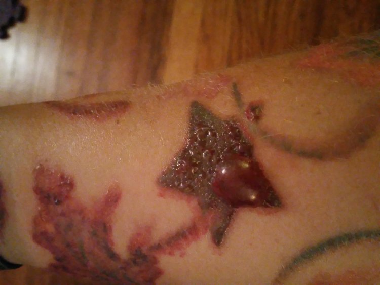Quick Recovery from Signs of Injury After Laser Tattoo Removal
