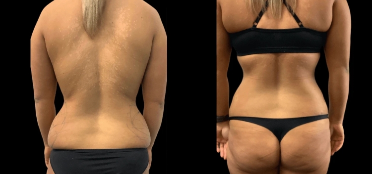 The Best Doctors in Dubai for Facial Fat Transfer: Restoring Volume Naturally