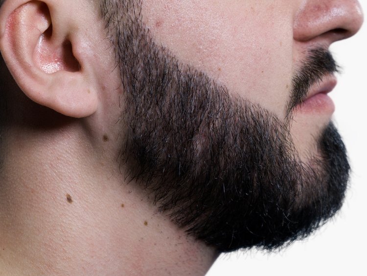 Can You Really Get a Fuller Beard with a Hair Transplant? Let’s Find Out