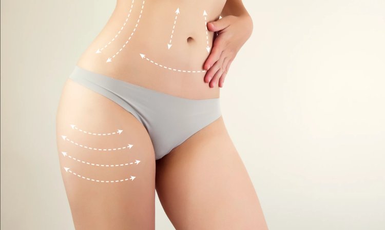 Essential Pre-Liposuction Guide Insights from Best Liposuction Surgeons in Dubai