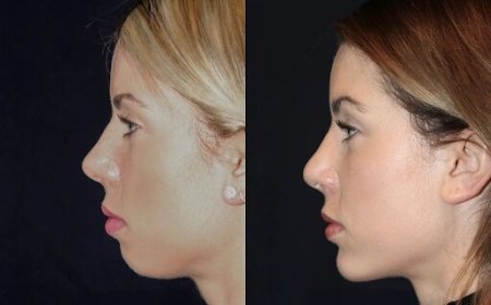 Best Doctors in dubai for Chin Fillers: What You Need to Know About Recovery