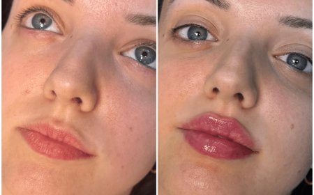 What Happens During a Juvederm Consultation with the Best Plastic Surgeon in Dubai?