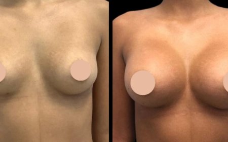 Best Breast Augmentation Surgeons in Dubai for You