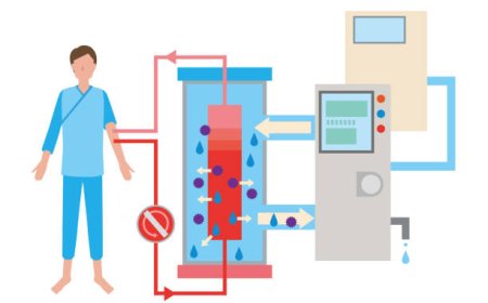 Setting Up Home Hemodialysis: A Beginner’s Guide