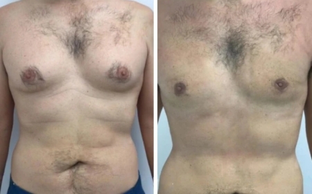 The Best Gynecomastia Surgeons in Dubai: Why You Should Trust Their Expertise