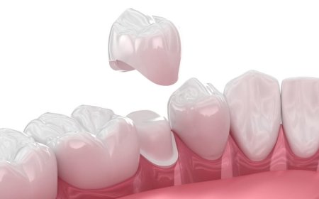 Dental Crowns in Dubai: Everything You Need to Know About the Procedure