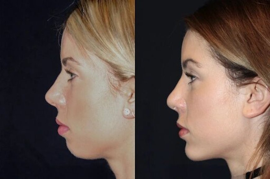 Best Doctors in dubai for Chin Fillers: What You Need to Know About Recovery