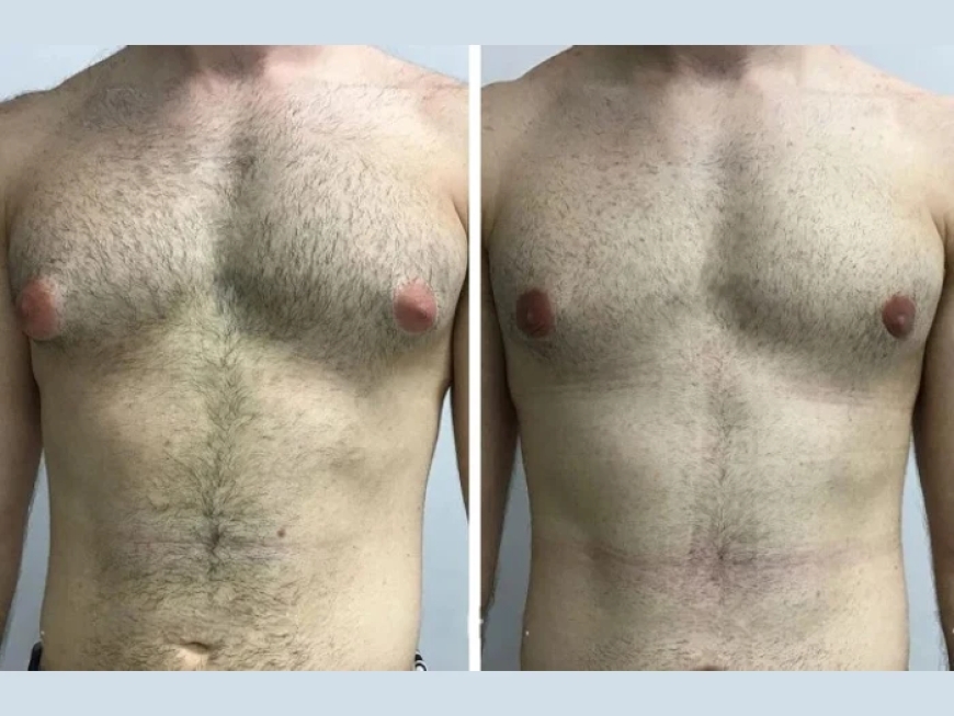 Why More Men Are Choosing the Best Gynecomastia Surgeons in Dubai for Their Transformation