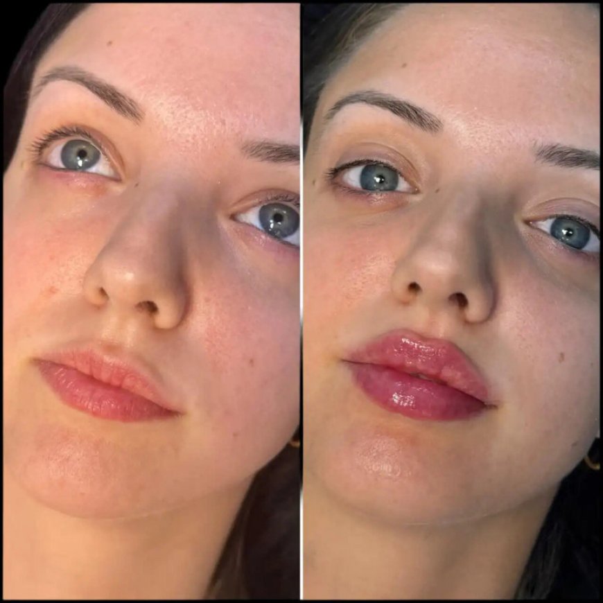 Best Aesthetic Clinics in dubai for Fillers: Non-Invasive Alternatives to Surgery