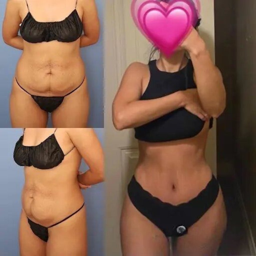 Tummy Tuck in Dubai with the Best Doctors: What You Should Know
