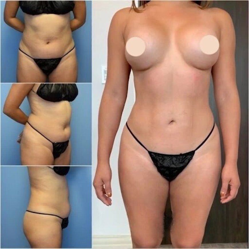Body Contouring in Dubai: What Sets It Apart from Other Cosmetic Procedures