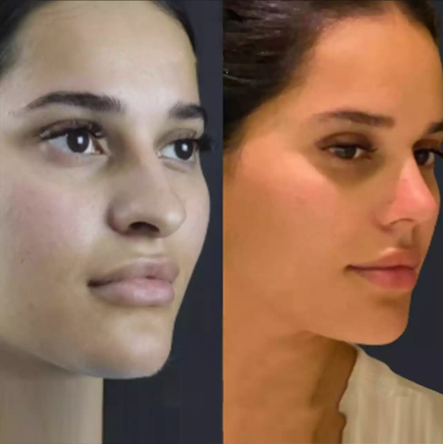 The Latest Trends in Rhinoplasty in Dubai