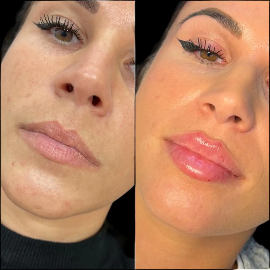 Discover the Best Aesthetic Clinics in dubai for Safe and Effective Dermal Fillers
