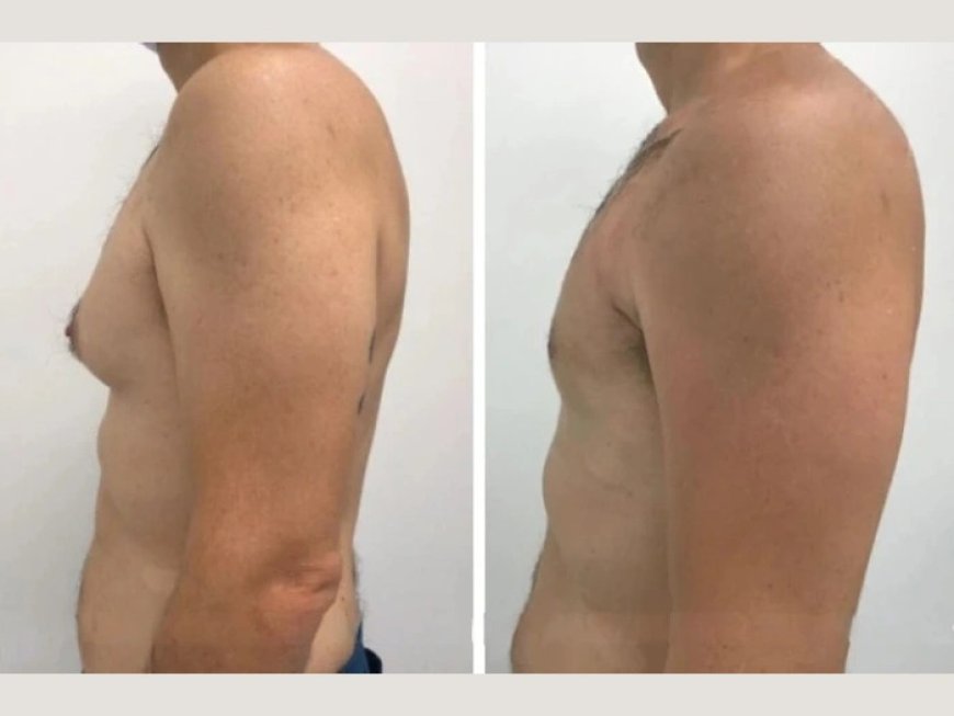 What is the Impact of Gynecomastia on Your Lifestyle in Dubai?