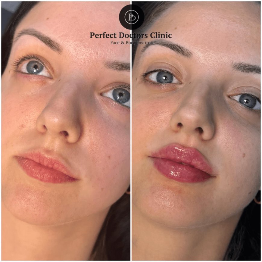 How Dermal Fillers in Dubai Can Correct Facial Asymmetry