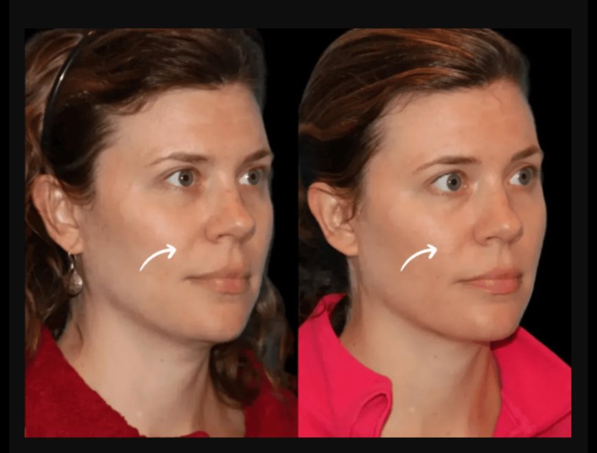 Avoiding Complications with Sculptra Fillers in Dubai