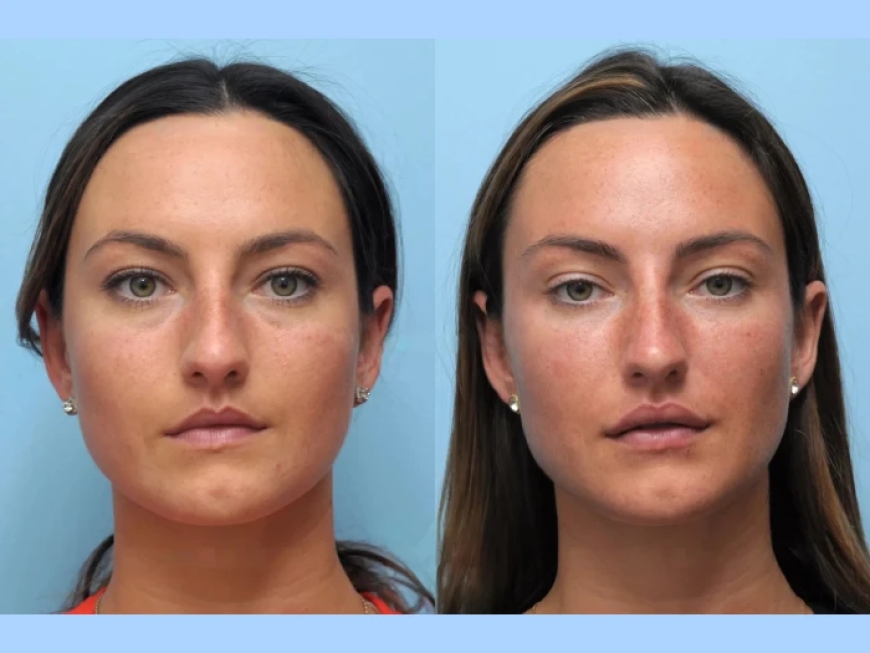 Is Thread Lift in Dubai Right for You? Here's What You Need to Know