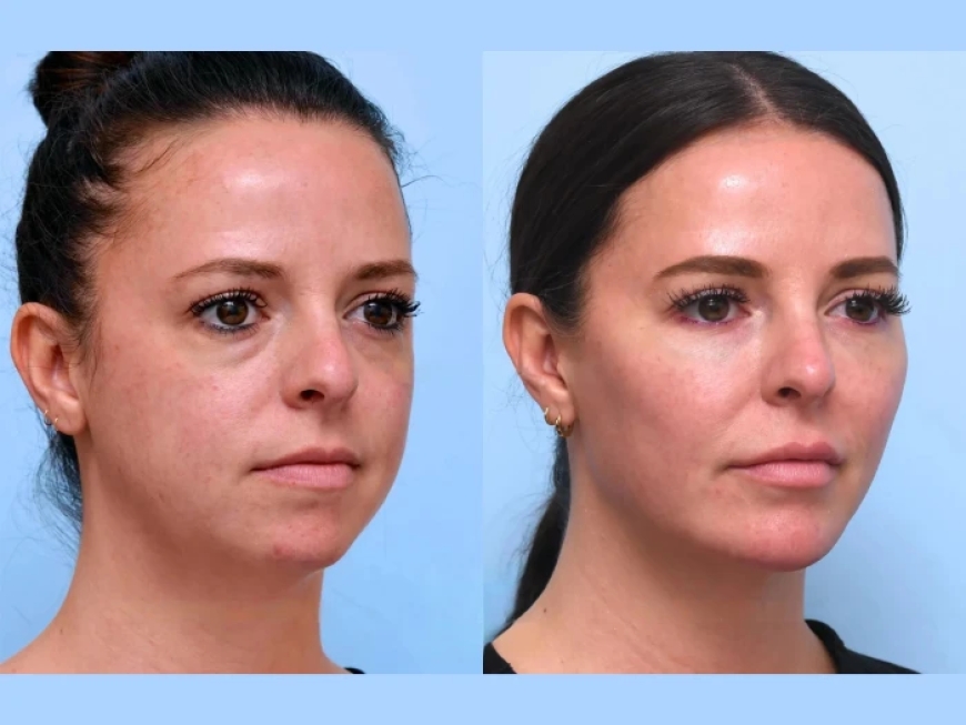 Preparing for Your First Thread Lift in Dubai: A Complete Guide
