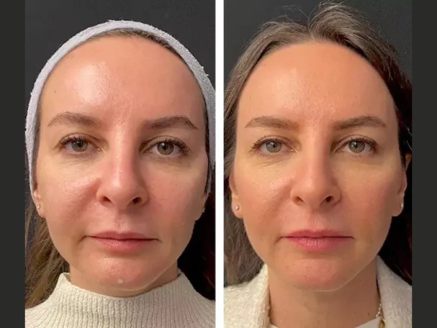 How the Best Plastic Surgeon in Dubai Uses Mesotherapy for Timeless Skin Rejuvenation