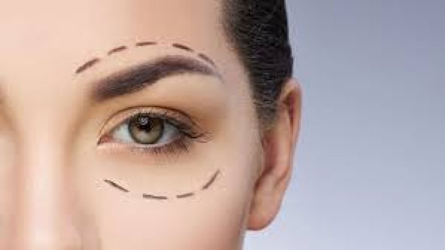 Upper Blepharoplasty in Jeddah: Revitalize Tired Eyes with Precision Eyelid Surgery