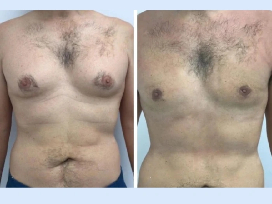 The Best Gynecomastia Surgeons in Dubai: Why You Should Trust Their Expertise