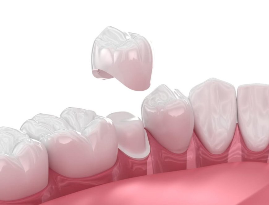 Dental Crowns in Dubai: Everything You Need to Know About the Procedure