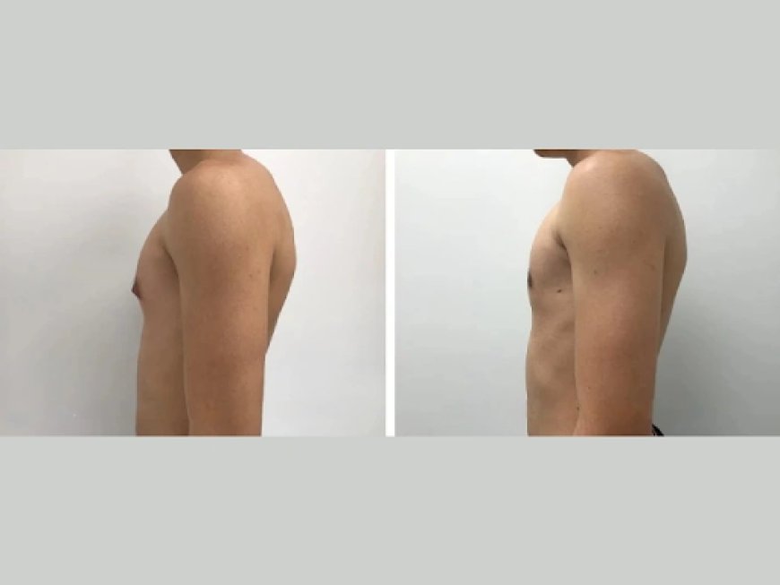 Signs and Symptoms of Gynecomastia Every Man in Dubai Should Know