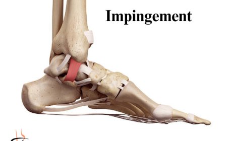 Anterior Ankle Impingement Recovery Plan (Step-by-Step)