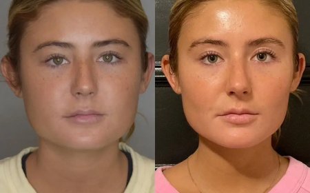 How Buccal Fat Removal Enhances Jawline Definition by the Best Buccal Fat Removal Surgeon in Dubai