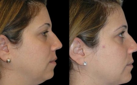 Double Chin Removal: How It Can Help You Age Gracefully, Explained by the Best Double Chin Removal Surgeon in Dubai