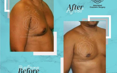 Expert Advice on Male Breast Reduction in Islamabad for Lasting Results
