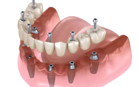 Discover the Benefits of Dental Implants Near You at Gateway Dentistry Group