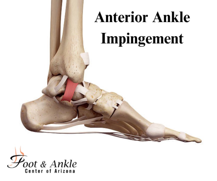 Anterior Ankle Impingement Recovery Plan (Step-by-Step)