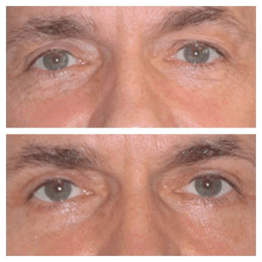 How to Get a Personalized Treatment Plan with the Best Eye Bag Removal Surgeon in Dubai