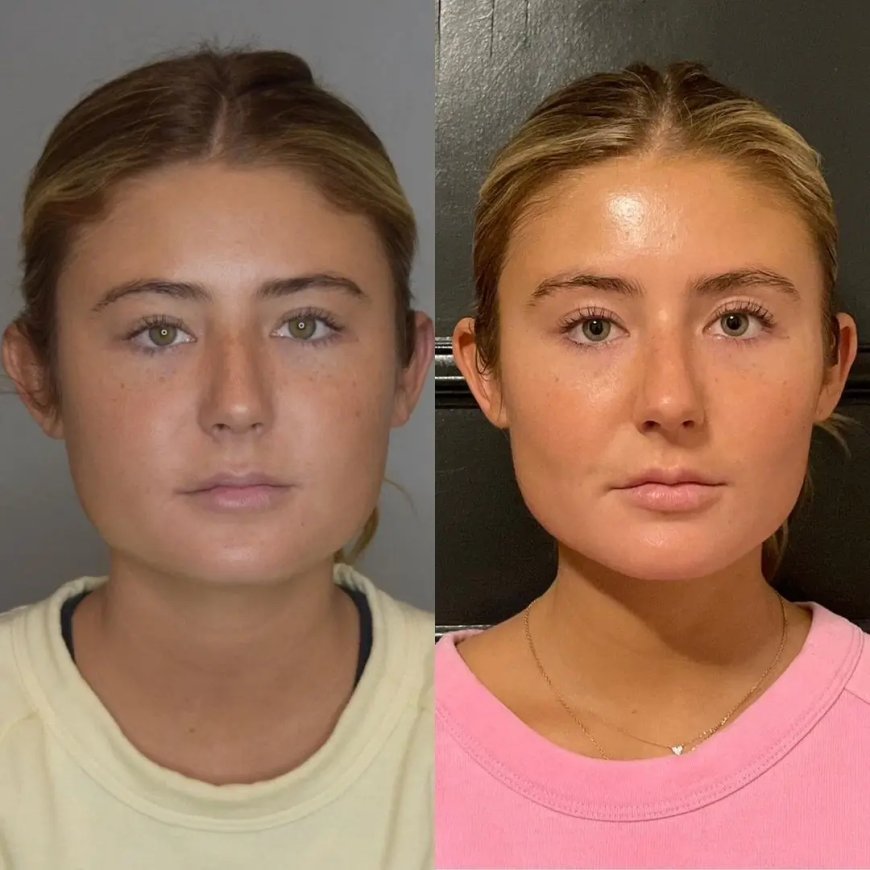 How Buccal Fat Removal Enhances Jawline Definition by the Best Buccal Fat Removal Surgeon in Dubai
